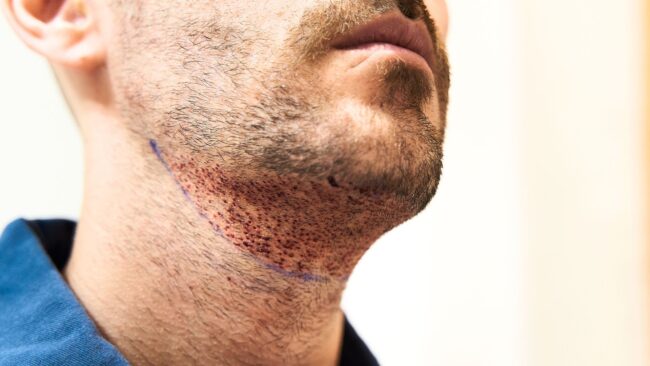 How beard transplant works in turkey? Medpera’s affordable beard transplant packages in Turkey with natural results.