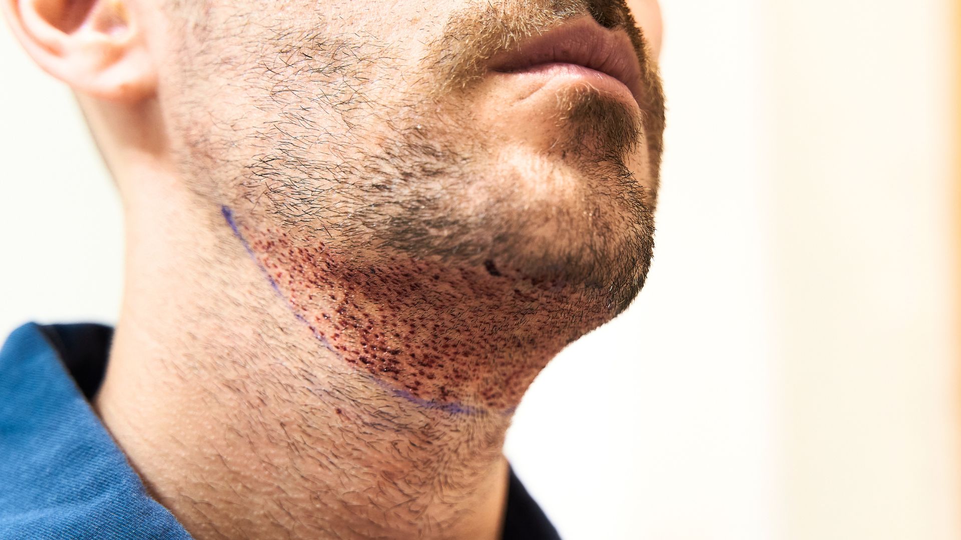 How Beard Transplant Works in Turkey How beard transplant works in turkey? Medpera’s affordable beard transplant packages in Turkey with natural results.