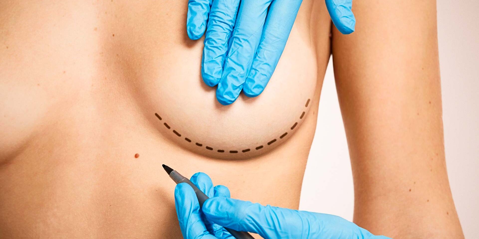 Medpera-blog – 4 Trusted breast lift treatments in Antalya by Medpera’s surgical team, braest lift in antalya