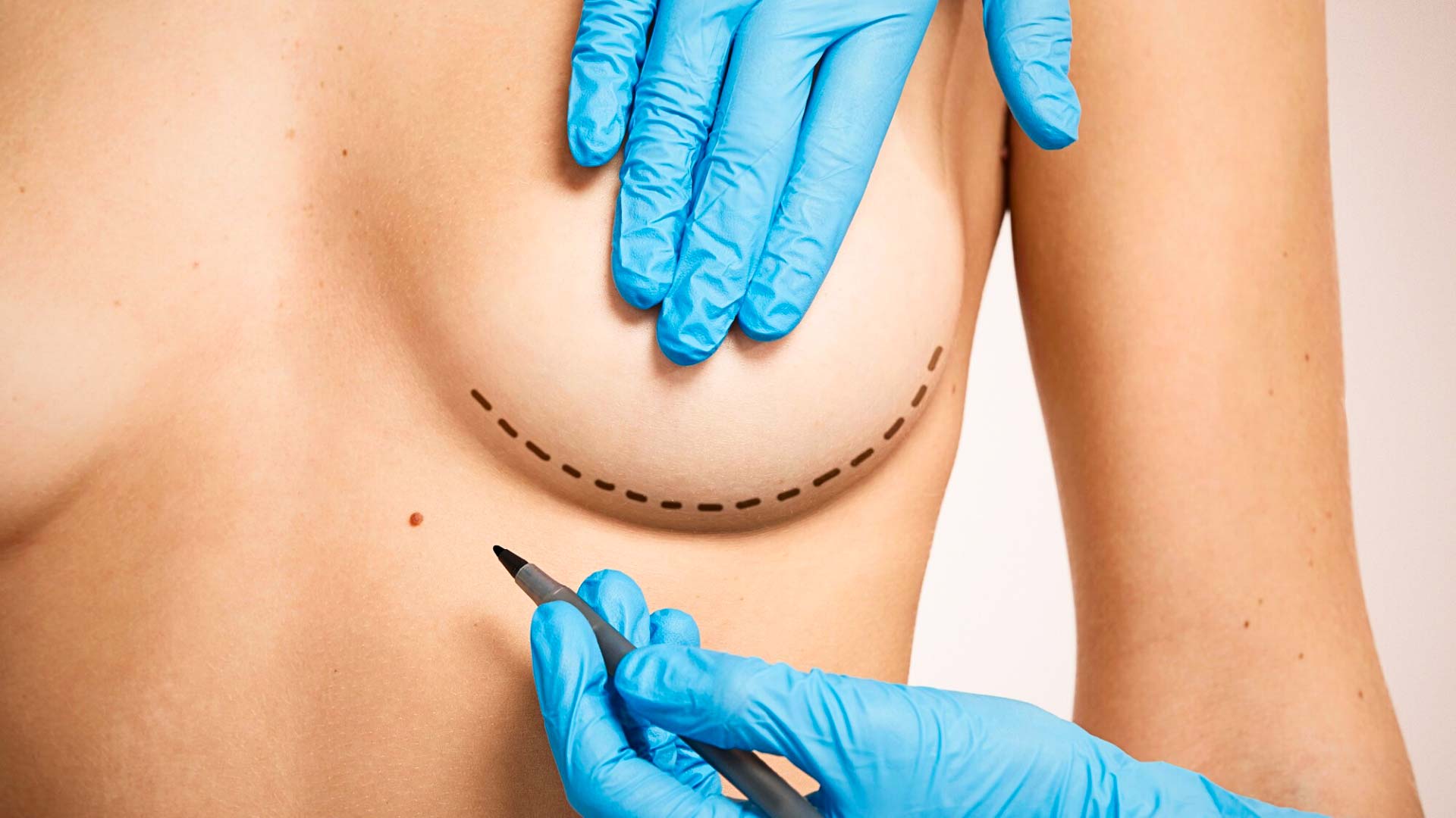 Trusted breast lift treatments in Antalya by Medpera’s surgical team, braest lift in antalya