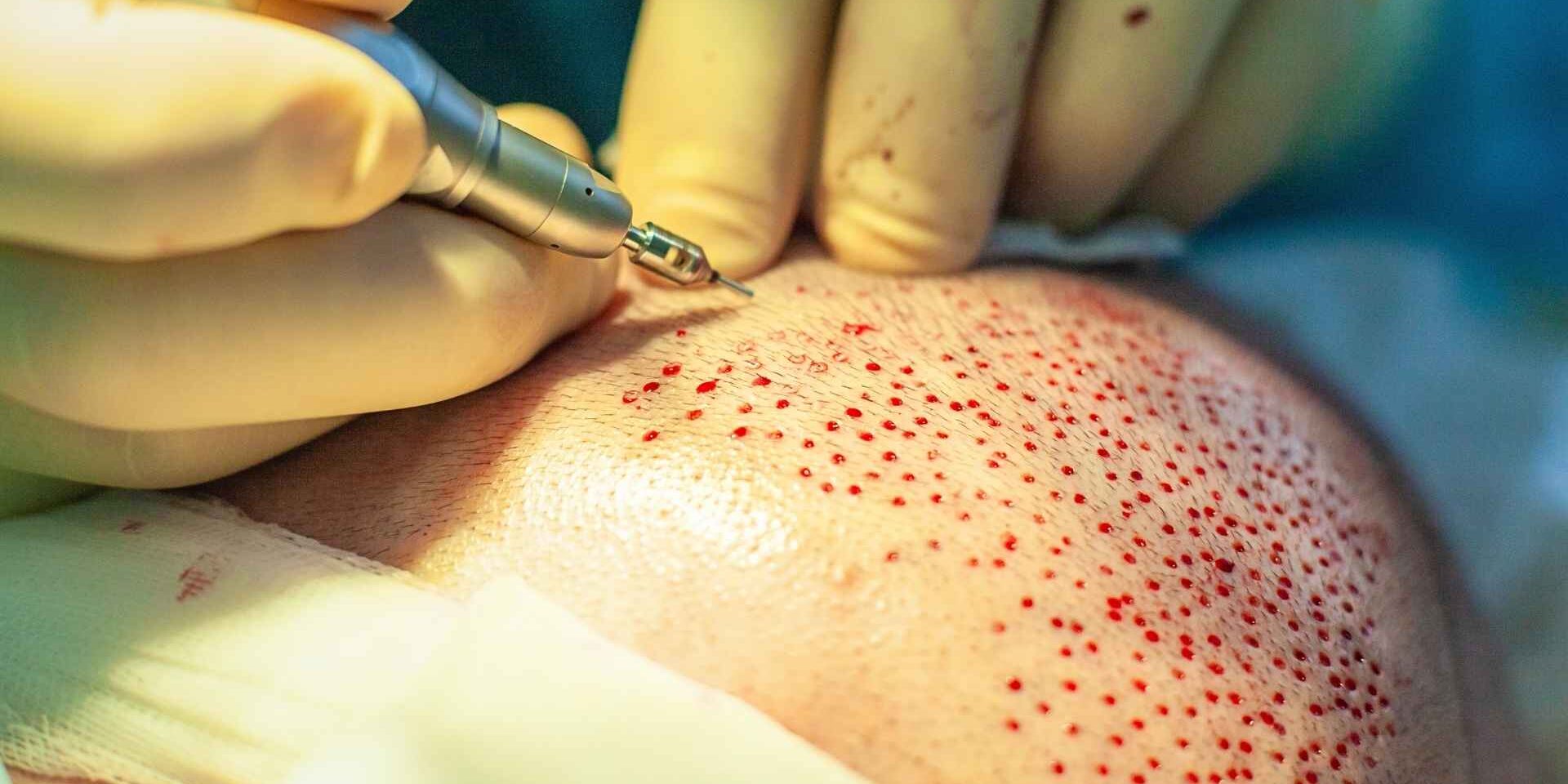 Medpera-haır transplant antalya Detailed breakdown of hair transplant costs in Antalya at Medpera Clinic