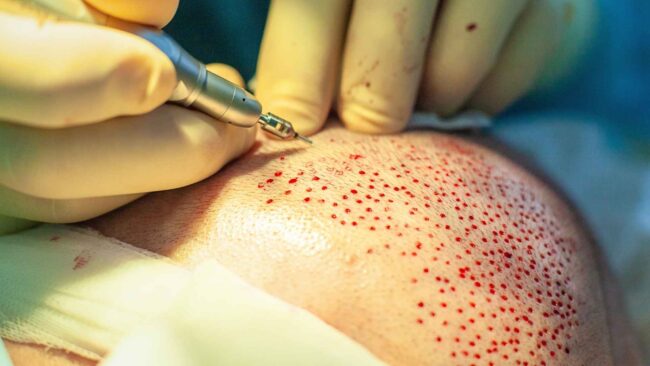 Detailed breakdown of hair transplant costs in Antalya at Medpera Clinic