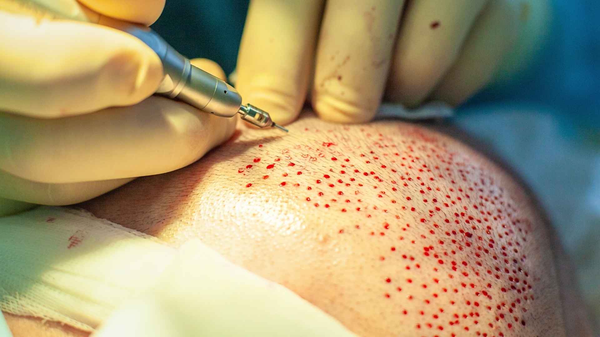 Detailed breakdown of hair transplant costs in Antalya at Medpera Clinic