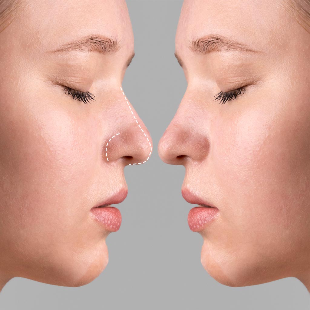 Rhinoplasty Surgery | Dental & Aesthetic Clinics Rhinoplasty Surgery in Antalya at Medpera Clinic