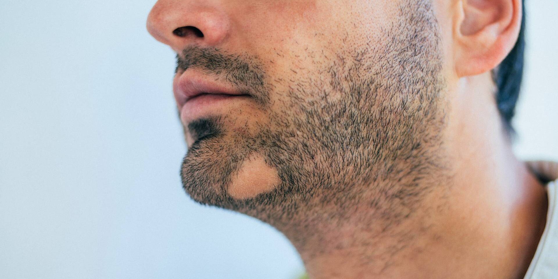 DHI vs FUE hair transplant in Antalya. FUE extracts and implants follicles via micro‑channels; DHI uses a specialized pen to implant grafts directly for higher precision