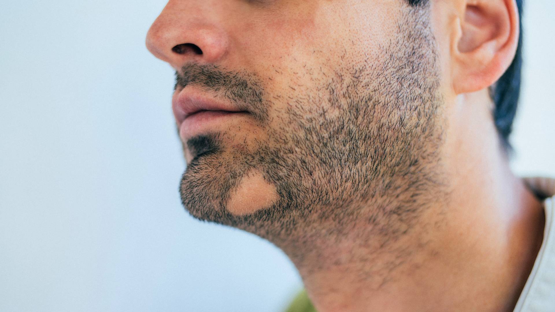 DHI vs FUE hair transplant in Antalya. FUE extracts and implants follicles via micro‑channels; DHI uses a specialized pen to implant grafts directly for higher precision