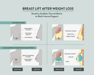 breast augmentation vs breast lift difference turkey